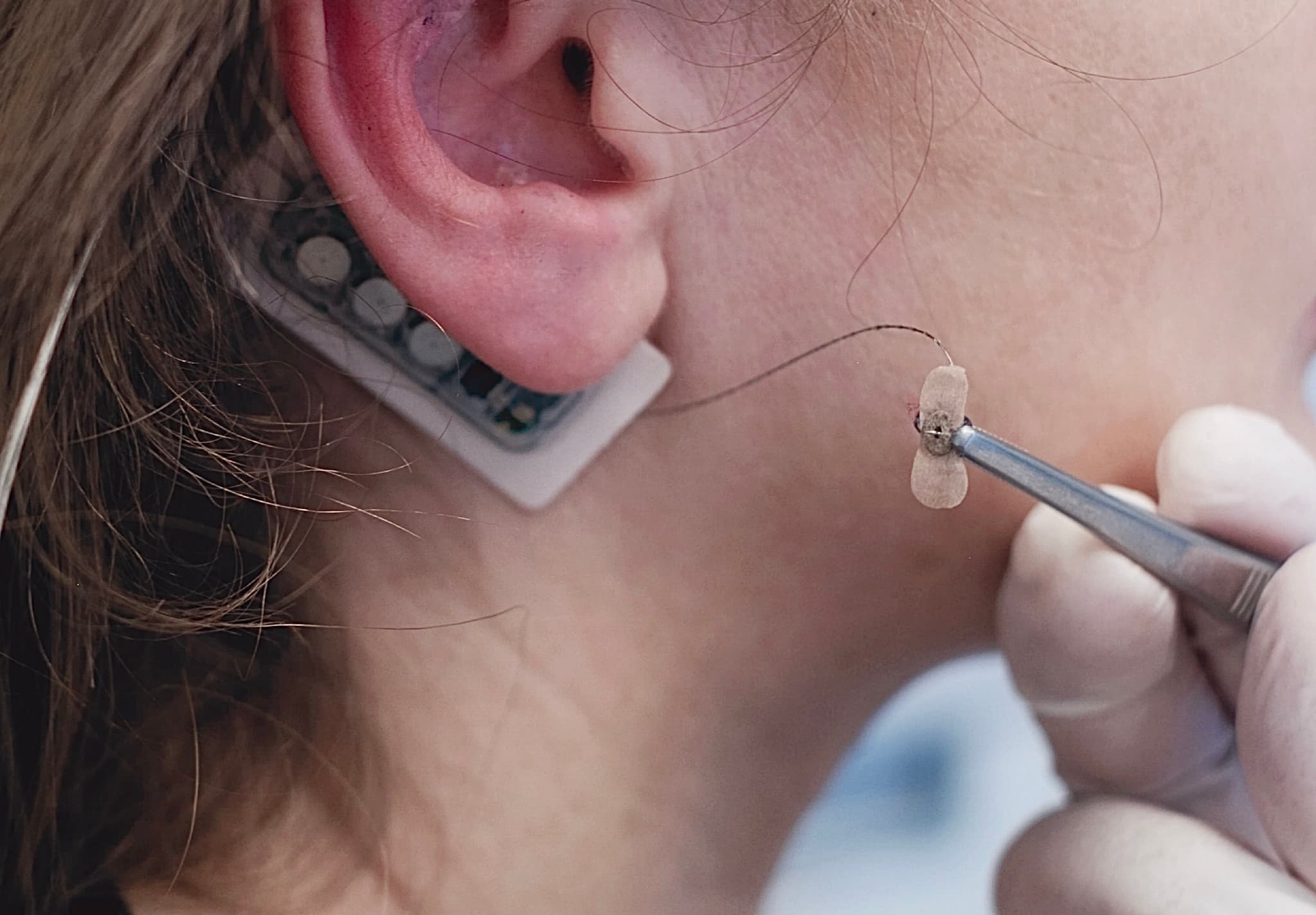 NeuMona being applied by clinician